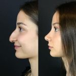 Rhinoplasty (nose job)